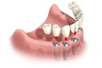 Perfect Smile implants supported full-bridge
